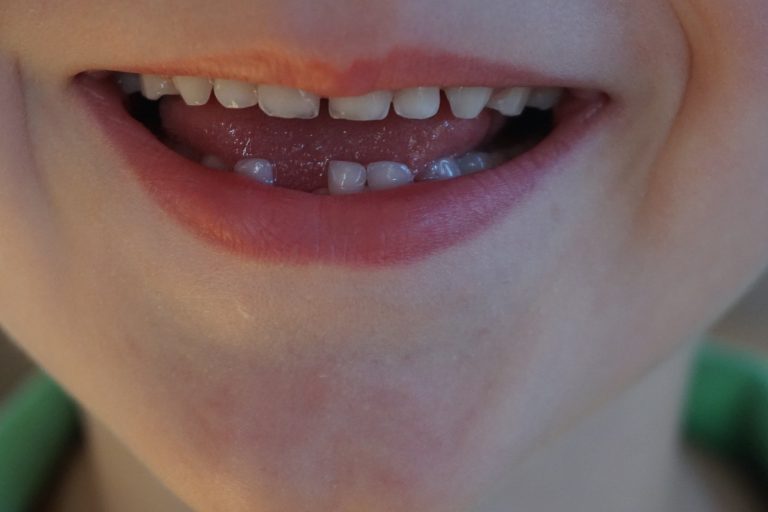 Combien de dents de lait tombent tout ce qu'il faut savoir sur la — free download